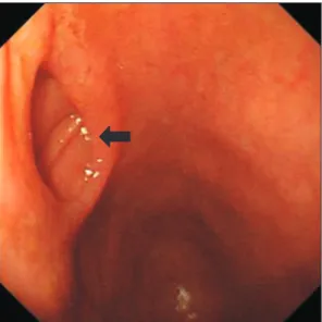 Fig. 1. Upper gastrointestinal endoscopy: Duodenal duplication was found in the second part of the duodenum  (arrow).