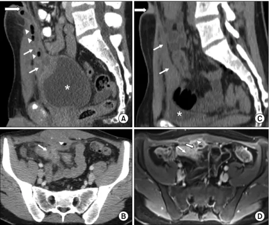 Fig. 1.  (A) Sagittal computed tomography (CT) image of the abdomen and pelvis demonstrating the urachus (white arrows) which  connects the urinary bladder (asterisk) and umbilicus (white arrow with black outline)