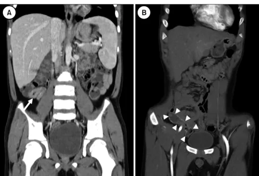 Fig. 2.  Abdominal computed  tomography image at initial  presentation (A) and 4 years  later (B)