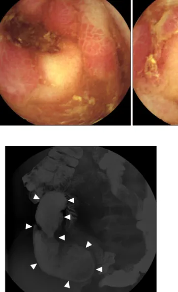 Fig. 4.  Small bowel barium study performed 4 years later  showing a contrast-filling structure (9.7 cm) outside and inferior to the terminal ileum, suspicious of Meckel’s diverticulum  (arrowheads).
