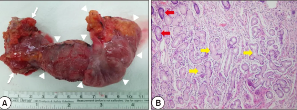 Fig. 5.  Diverticulectomy specimen (A) and histology (B). The specimen shows a segment of the ileum with a Meckel’s diverticulum  (arrowheads) of approximately 9-cm length (arrows) (A)