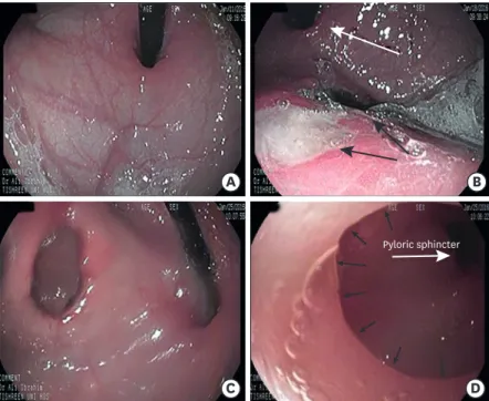 Fig. 1. Development of the ulcers and the consequent orifice, along with the cyst connection to the pylorus
