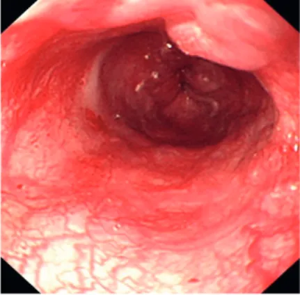 Fig. 2. Endoscopic view of grade II esophageal varices. An endoscopic view of the second esophageal varices at 12  o'clock position which extends from the level of 15 cm to the gastroesophageal junction at the level of 21 cm.