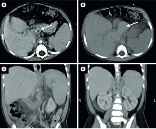 Fig. 3. CT angiogram. (A) Contrast enhanced axial CT scan of the abdomen showing dilated tortious vessels at the  porta-hepatis and peripancreatic areas (arrow), in keeping with cavernous transformation of portal vein caused  by portal hypertension