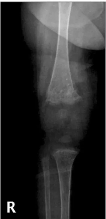 Fig. 1. Rickets and osteoporosis of right knee in the patient.