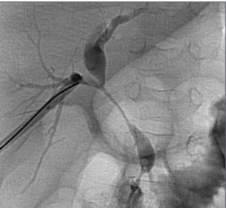 Fig. 2. Final cholangiogram demonstrating resolutions of both common hepatic duct and common bile duct  stricture.