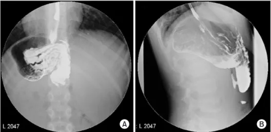 Fig. 1. (A, B) Upper gastrointestinal study shows delayed contrast media with antral deformity.