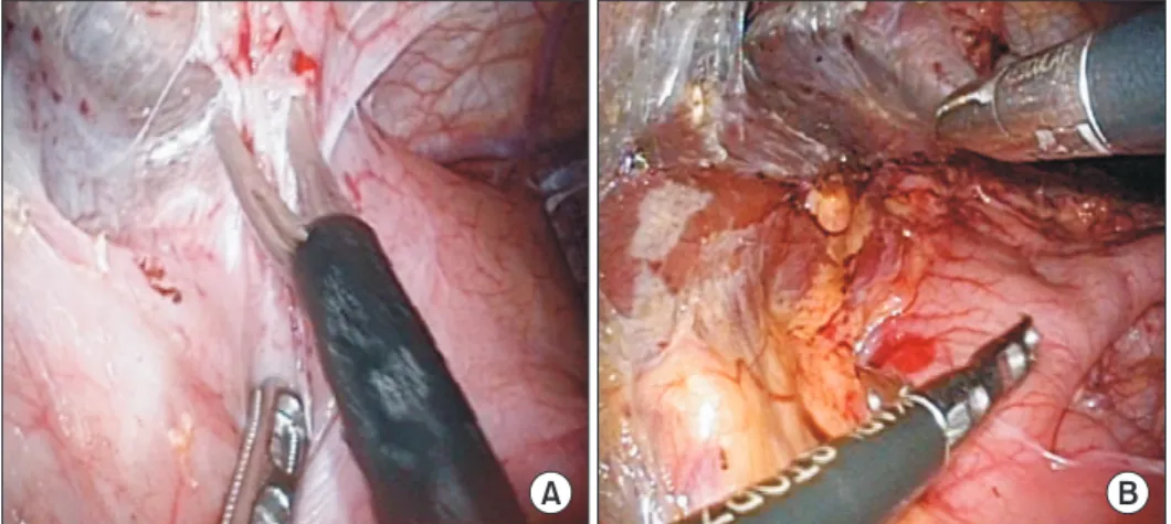 Fig. 2. (A) Operative finding shows multiple adhesions in the abdominal wall. (B) Operative finding shows greater  curvature of stomach attached to the liver.