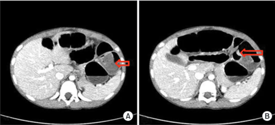 Fig. 3. A 4.5 cm polyp after polypectomy.
