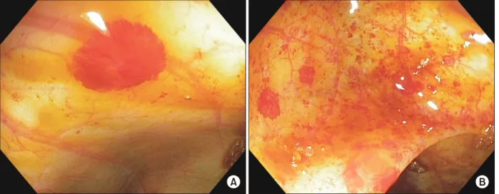 Fig. 1.  (A) Angioectasia at the hepatic flexure, (B) diffuse angioectasias of the ascending colon.