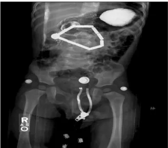 Fig. 1.  Upper gastrointestinal series shows a series of foreign  bodies attached end-to-end and looping from the stomach  through the duodenum.