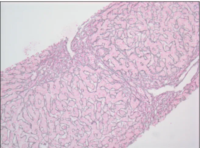 Fig. 1.  Rosetting and few sinusoidal mature lymphocytes  (H&amp;E, ×200).