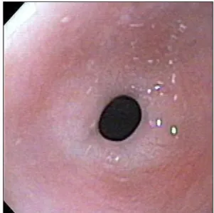 Fig. 2.  Endoscopic  view  of  antral web ablation. Mucosal  tearing is evident by gaps within the gray mucosal tissue  revealing dark muscular tissue of the pylorus underneath as  viewed endoscopically through the balloon