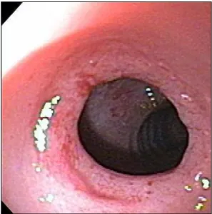 Fig. 3.  Antrum post balloon dilation of antral web. Normal  pyloric canal and duodenal mucosa posterior to area of  dilation.