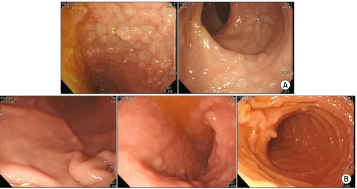 Fig. 1.  (A) Colonoscopy showed multiple polyps on the terminal ileum. Some flat polyps without neck were noted on the rectum
