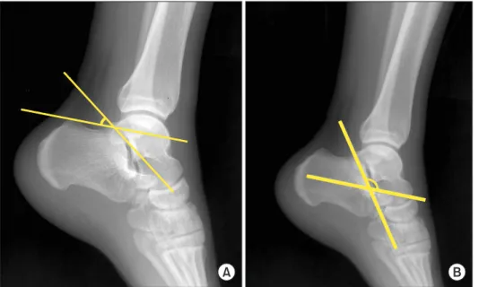 Figure 1. Measurement of Bohler and  Gissane angles. (A) Bohler angle is  mea-sured by the intersection of a line drawn  from most cephalic point on tuberosity to  highest point of posterior facet with a line  from highest point of posterior facet to  most
