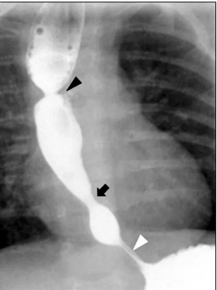 Fig. 2.  Esophagography of a patient with double congenital  esophageal stenosis. The sites of stricture were founded in the  middle portion (arrow) and the lower 3rd portion of the  esophagus (arrowhead).