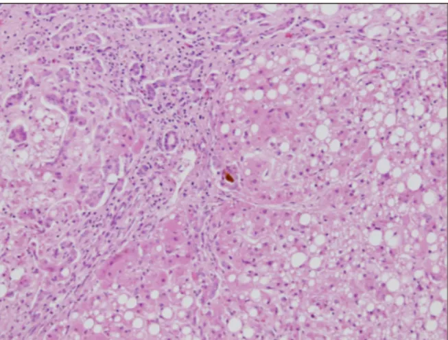 Fig. 1.  Liver histopathology (H&amp;E, ×100). The histopathology  confirmed marked fatty change, cholestasis, ballooning  degeneration and marked ductular proliferation, favoring  metabolic disease.