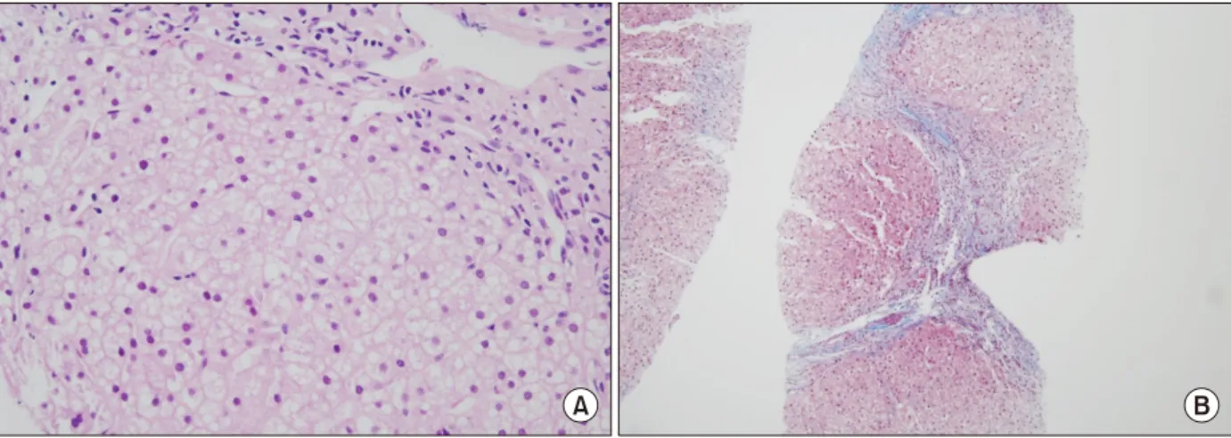 Fig. 1.  Light microscopy examination of the liver biopsy tissue showed (A) diffuse microvesicular fatty changes in hepatocytes  (H&amp;E, ×200) and (B) septal fibrosis (Masson-trichrome, ×40).
