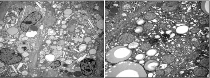 Fig. 2.  Electron microscopy examination of the liver tissue revealed macrophages with numerous lipid-filled lysosomes at the portal  area and hepatocytes that contained many large glycogen particles and cholesterol clefts (×400).