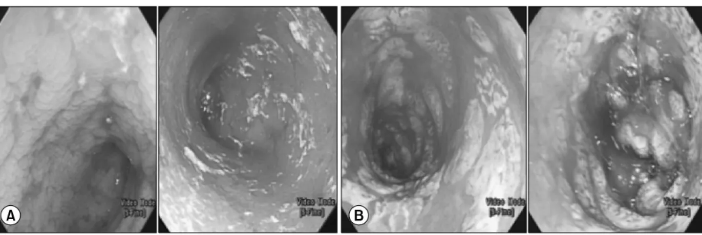 Fig. 3.  Duodenum of three patients. They showed grade 5 ulceration, exudate, and bleeding in endoscopy