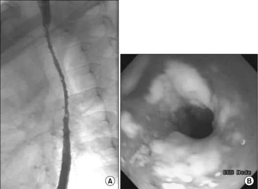 Fig. 1.  Initial esophageal  stricture and candidiasis. (A) There were diffuse strictures  and multiple small  diverti-culum in the mid-esophagus  (thoracic vertebrae 3 levels)  on esophagography when he was 8 years old