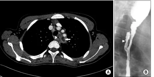 Fig. 2.  Mediastinal abscess  on chest computed  tomo-graphy (CT) and fistulous  tract on esophagogram