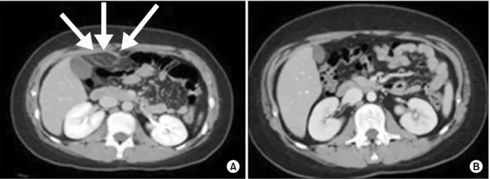 Fig. 1.  (A) Initial abdominal computed tomography (CT) scan showed increased attenuation and enhancement of omental fat  as well as anterior peritoneal wall thickening and enhancement (arrows)
