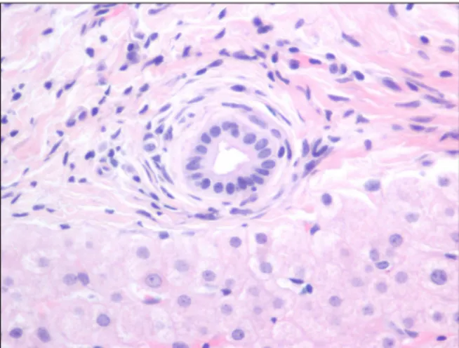 Fig. 2.  Bile duct is surrounded by concentric layers of fibrosis  (H&amp;E, ×400).