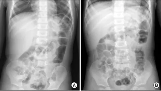 Fig. 2.  Abdominal pelvic computed tomography. (A) Intussusceptions: ileocolic type intussusception without strangulation and  significant obstruction (axial view, arrow)