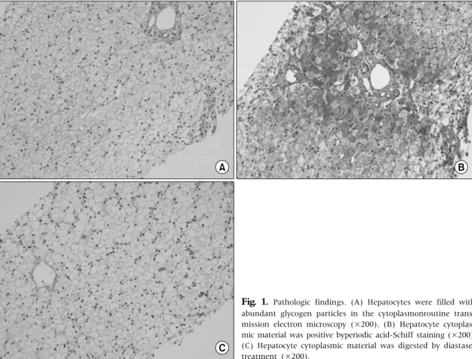 Fig. 1.  Pathologic findings. (A) Hepatocytes were filled with  abundant glycogen particles in the cytoplasmonroutine  trans-mission electron microscopy (×200)