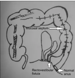 Fig. 5.  Mucosal resection (arrow-mucosal cuff) of the distal  duplicated colon.
