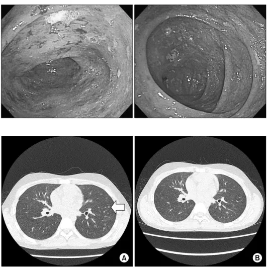 Fig. 1.  Colonoscopy demon- demon-strates diffuse symmetric  ery-thematous mucosa with  exu-dates from cecum to sigmoid  colon, shallow ulcer at  trans-verse colon.