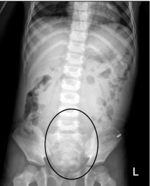 Fig. 1.  Simple abdominal X-ray shows faint rectal gas and a  large amount of fecal materials in the distal colon (circle).