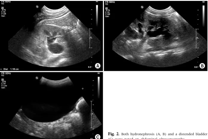 Fig. 3.  Coronal (A) and saggital views (B) of whole abdominal computed tomography show that the distal part of the colon  is markedly dilated and contains heterogeneous materials  consisting of impacted feces (lined arrows)