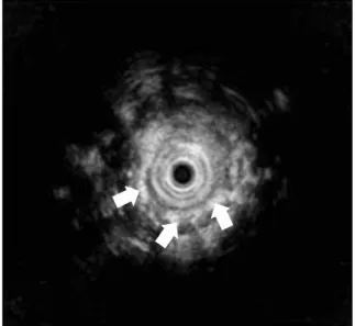 Fig. 4.  Histologic picture of the resected specimen shows  bronchial cartilage (blue arrow), mucus glands (yellow arrow), and ciliated respiratory epithelium (black arrow) in the  esophageal wall (hematoxylin and eosin, ×40).