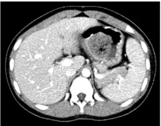 Fig. 1.  Abdominal computed tomography (CT) scan shows a  4 cm sized low attenuating mass-like lesion in the stomach.