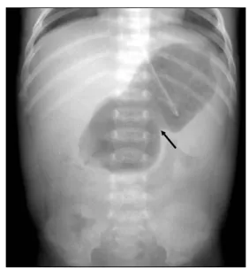 Fig.  6.  Necrotizing  enterocolitis.  Supine  view  shows  diffusely  dilated  bowels  with  linear  intramural  gases  (short  arrows)  (pneumatosis  cystoides  intestinalis)  and  also  multiple  linear  and  branching  airs  (long  arrows)  in  the  li