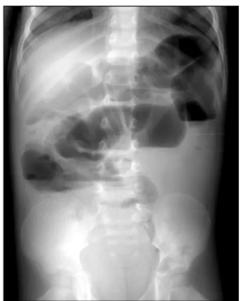 Fig.  10.  Appendicitis  with  an  appendicolith.  Supine  view  illu- illu-strates  the  presence  of  a  faecolith  in  the  right  lower  quadrant  (short  arrows)  and  loss  of  the  right  psoas  outline  (long  arrows)