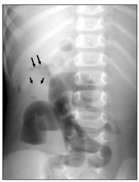 Fig.  11.  Intussusception  with  the  'target'  and  'meniscus'  signs.  Supine  view  shows  a  round  soft-tissue  mass  in  the  right  upper  quadrant