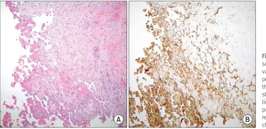 Figure 6. Pathologic features. (A) Myriad  small delicate papillae project into the  vascular lumen