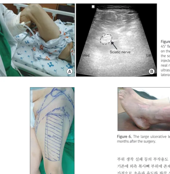 Figure 4. (A) With the hip joint in 30 o ∼ 45 o  flexion, an ultrasound probe is placed  on the posterior surface of thigh to detect  the sciatic nerve