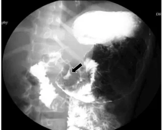 Fig.  1.  UGI  series  shows  a  stricture  at  the  antral  portion  and  an  ulcer  crater  with  regular  radiating  mucosal  folds  (arrow).
