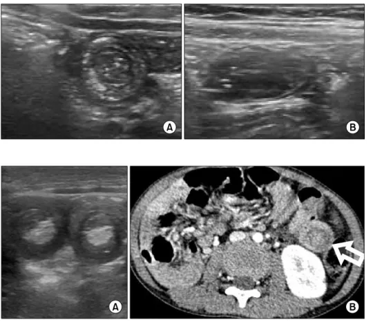 Fig.  2.  US  (A)  and  CT  scan  (B)  of  a  5-year-old  boy  with  recurrent  abdominal  pain  and  melena  who  underwent   sur-gical  reduction  of  small  bowel  intussusceptions  at  multiple  sites  (arrow)