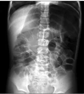 Fig.  2.  Barium  study  shows  progressive  tapered  rectosigmoid  tract  (arrow)  and  dilated  proximal  sigmoid  loop
