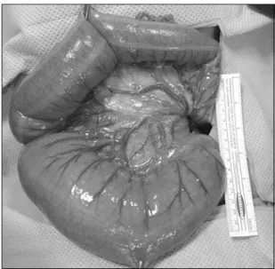 Fig.  3.  Abdominal  computed  tomography  shows  the  'whirl  sign'  (arrow)  caused  by  torsion  of  the  sigmoid  mesentery