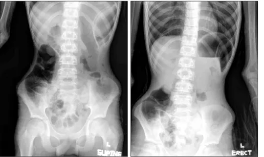 Fig.  1.  A  plain  abdominal  X-ray  revealing  substantial   en-largement  of  the  stomach