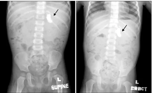 Fig.  1.  A  plain  abdominal  X-ray  reveals  an  elliptical   cal-cifications  (arrow)  in  the  LUQ  area.증            례　환　아:  임○○,  2세,  남아　주　소:  내원 3일 전부터 시작한 구토와 복부 팽만 　현병력:  최근 환아의 복부가 불러 보이던 중 내원 3일 전부터 간헐적인 구토가 있어 외래를 방문하였다.　과거력:  38주 4일,  2.83  k