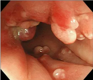 Fig.  1.  Initial  multiple  polyps  with  ulcerations  were  noted  just  above  the  anal  verge  at  the  first  visit.