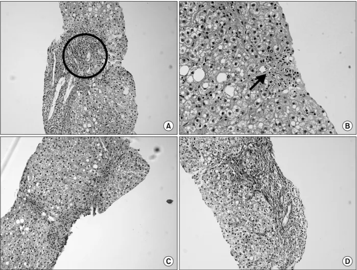 Fig.  1.  Liver  biopsy.  Interface  hepatitis:  Infiltration  of  many  mononuclear  cells  (circle)  is  seen  (A)  (H&amp;E  stain,  ×100)